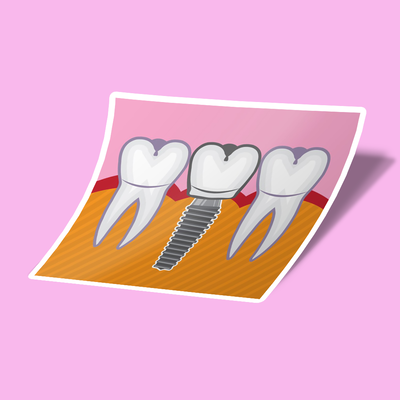 استیکر Tooth Implant